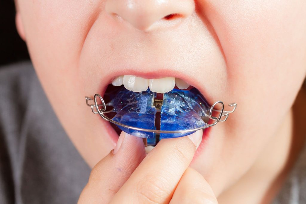 マウスピース矯正装置をつけようとしている子ども