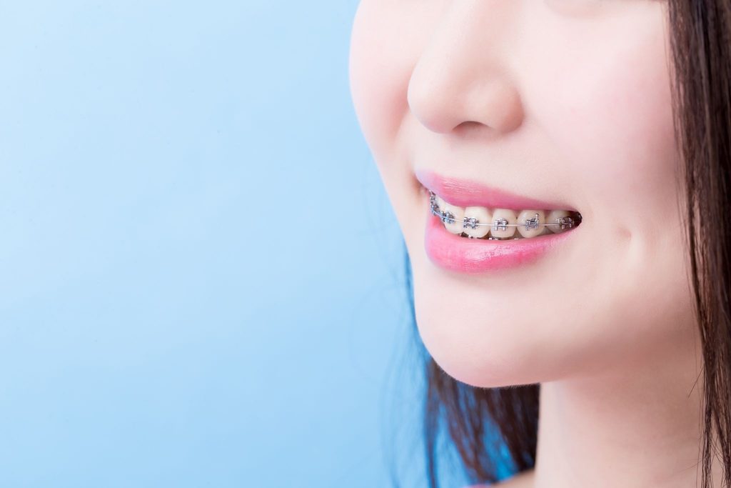 ワイヤー矯正装置をつけた女性
